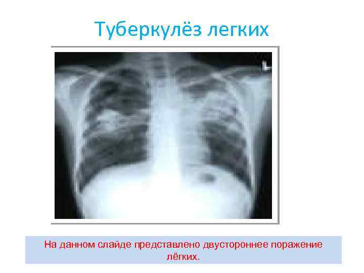 Туберкулёз легких На данном слайде представлено двустороннее поражение лёгких. 