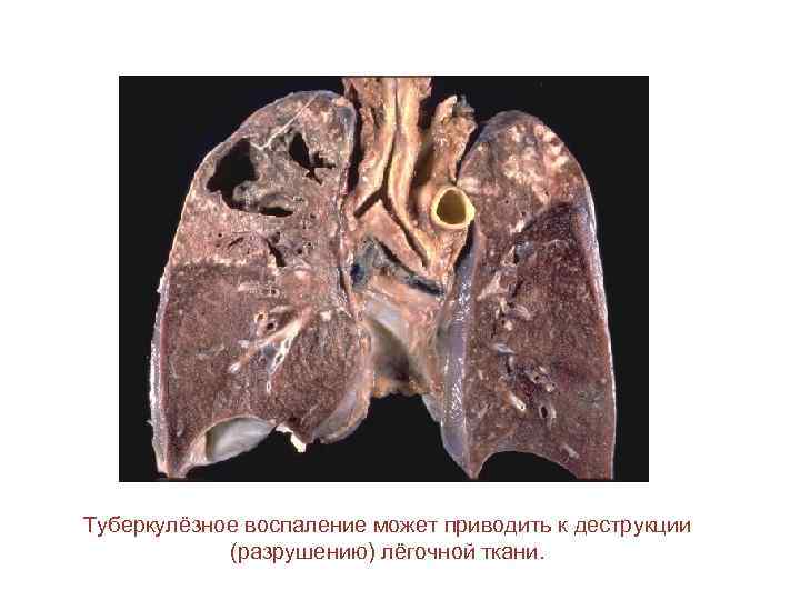 Туберкулёзное воспаление может приводить к деструкции (разрушению) лёгочной ткани. 