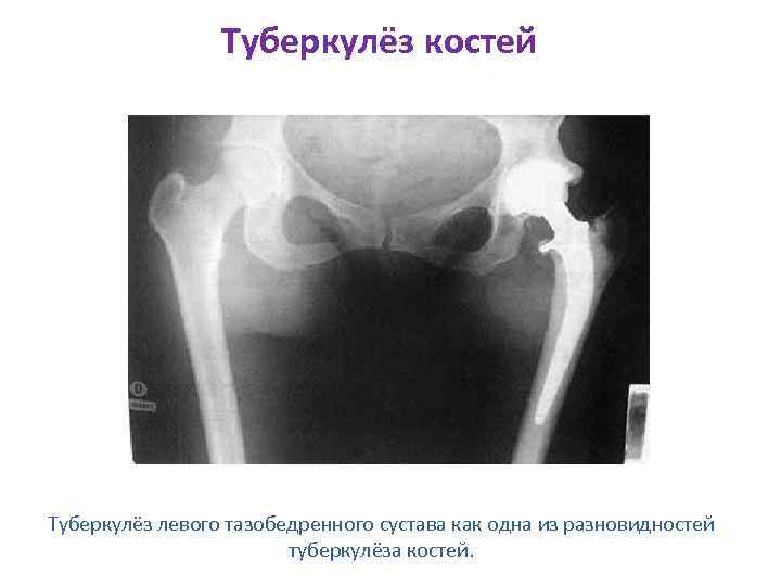 Туберкулёз костей Туберкулёз левого тазобедренного сустава как одна из разновидностей туберкулёза костей. 