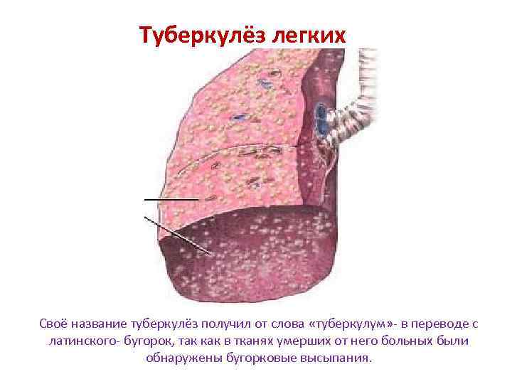 Туберкулёз легких Своё название туберкулёз получил от слова «туберкулум» - в переводе с латинского-