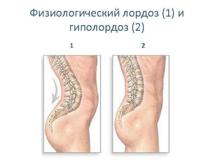 Физиологический лордоз (1) и гиполордоз (2) 1 2 