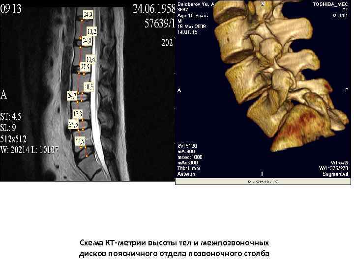 Схема КТ-метрии высоты тел и межпозвоночных дисков поясничного отдела позвоночного столба 