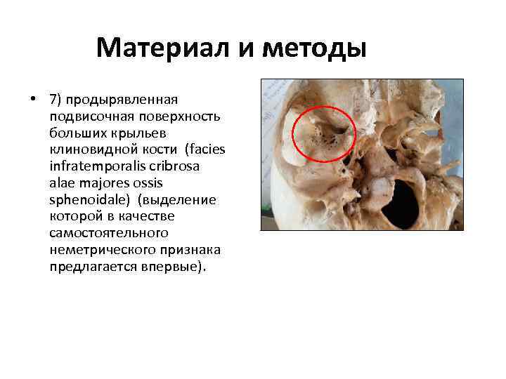 Материал и методы • 7) продырявленная подвисочная поверхность больших крыльев клиновидной кости (facies infratemporalis