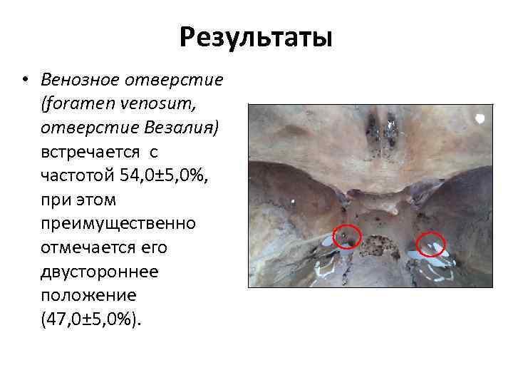 Результаты • Венозное отверстие (foramen venosum, отверстие Везалия) встречается с частотой 54, 0± 5,