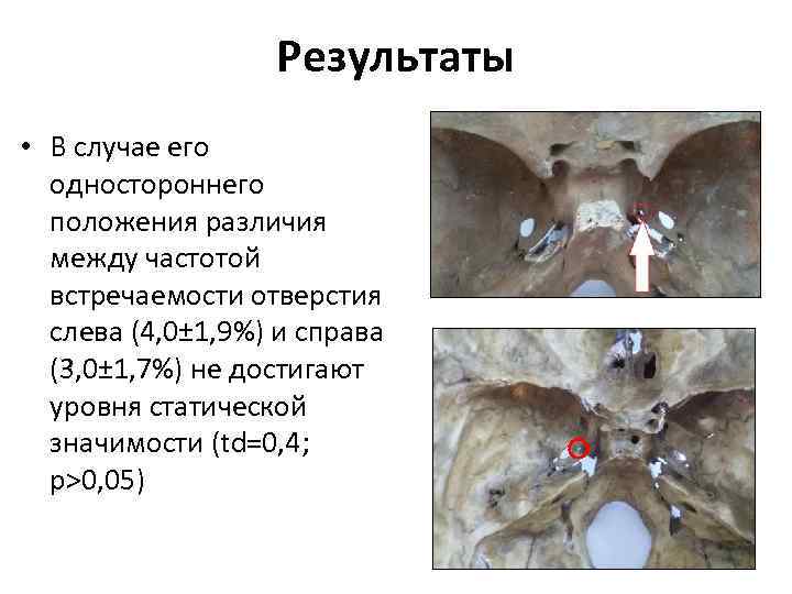 Результаты • В случае его одностороннего положения различия между частотой встречаемости отверстия слева (4,