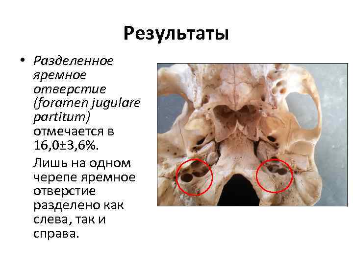Результаты • Разделенное яремное отверстие (foramen jugulare partitum) отмечается в 16, 0± 3, 6%.