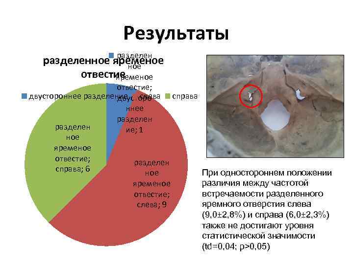 Результаты разделенное яременое отвестие; двустороннее разделение слева справа двусторо ннее разделен ие; 1 ное