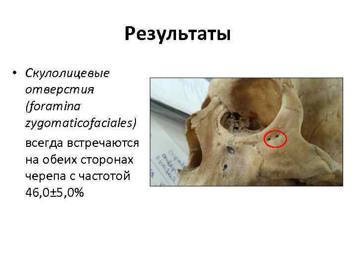 Результаты • Скулолицевые отверстия (foramina zygomaticofaciales) всегда встречаются на обеих сторонах черепа с частотой