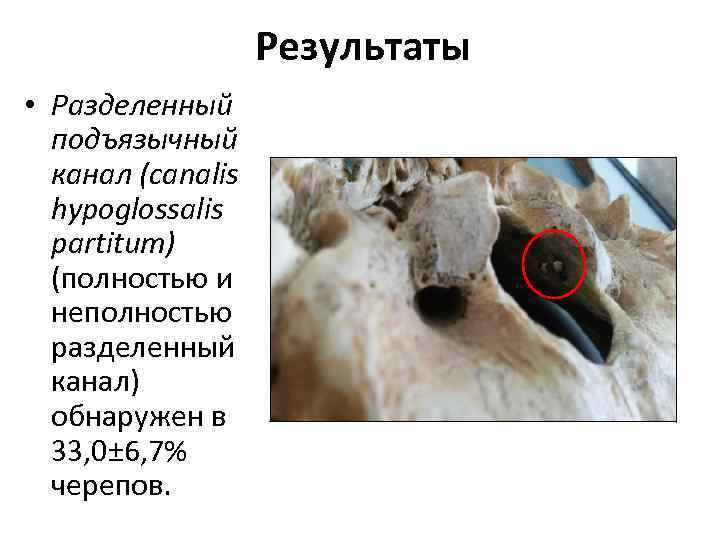 Результаты • Разделенный подъязычный канал (canalis hypoglossalis partitum) (полностью и неполностью разделенный канал) обнаружен