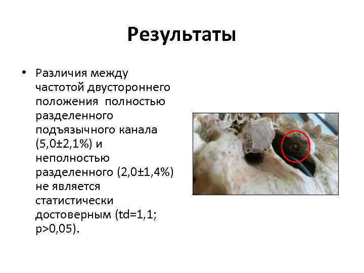 Результаты • Различия между частотой двустороннего положения полностью разделенного подъязычного канала (5, 0± 2,