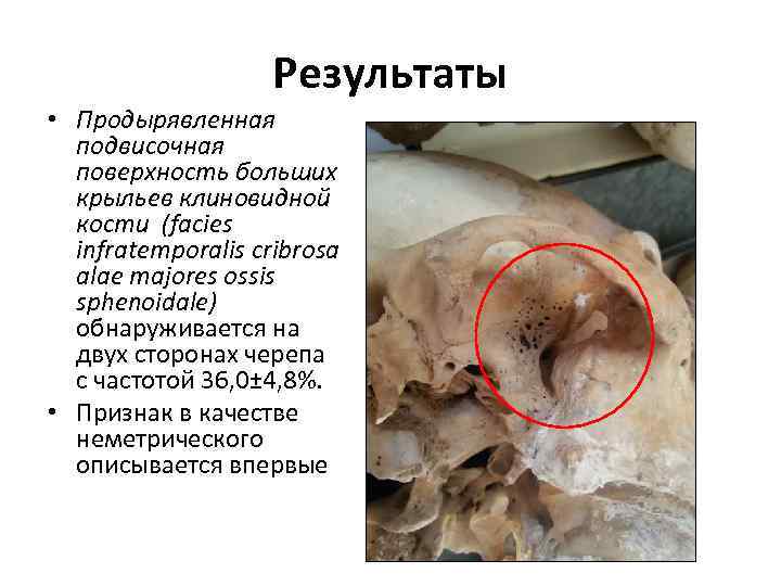 Результаты • Продырявленная подвисочная поверхность больших крыльев клиновидной кости (facies infratemporalis cribrosa alae majores
