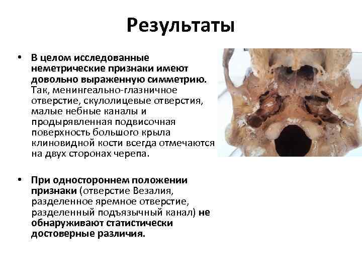 Результаты • В целом исследованные неметрические признаки имеют довольно выраженную симметрию. Так, менингеально-глазничное отверстие,