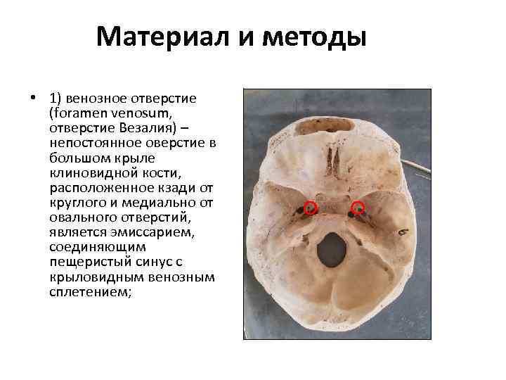 Материал и методы • 1) венозное отверстие (foramen venosum, отверстие Везалия) – непостоянное оверстие