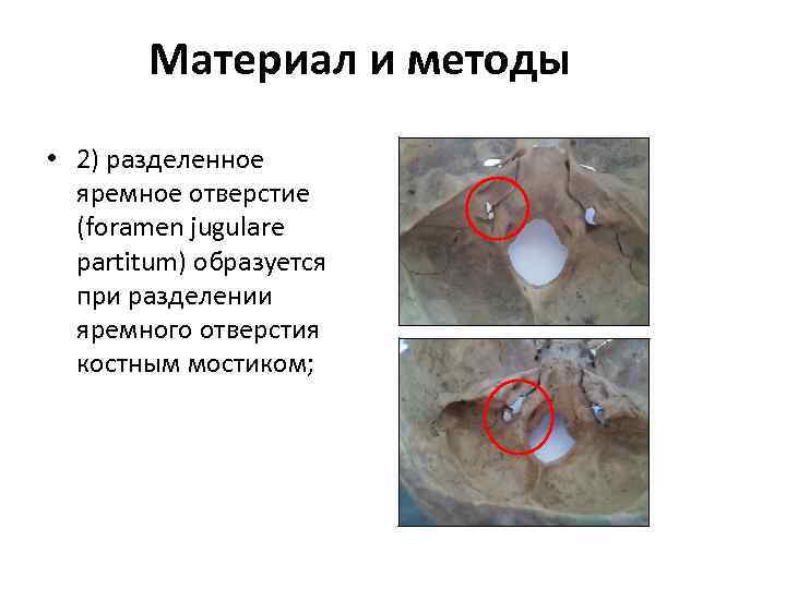 Материал и методы • 2) разделенное яремное отверстие (foramen jugulare partitum) образуется при разделении