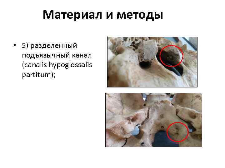 Материал и методы • 5) разделенный подъязычный канал (canalis hypoglossalis partitum); 