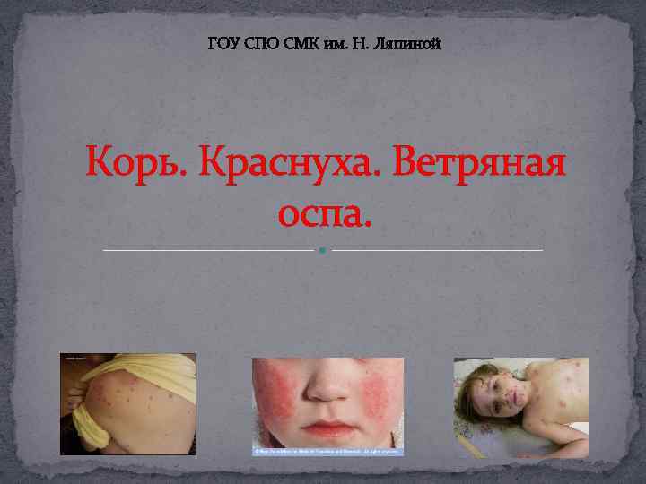 ГОУ СПО СМК им. Н. Ляпиной Корь. Краснуха. Ветряная оспа. 