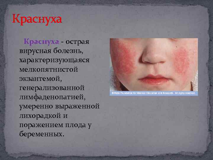 Краснуха - острая вирусная болезнь, характеризующаяся мелкопятнистой экзантемой, генерализованной лимфаденопатией, умеренно выраженной лихорадкой и