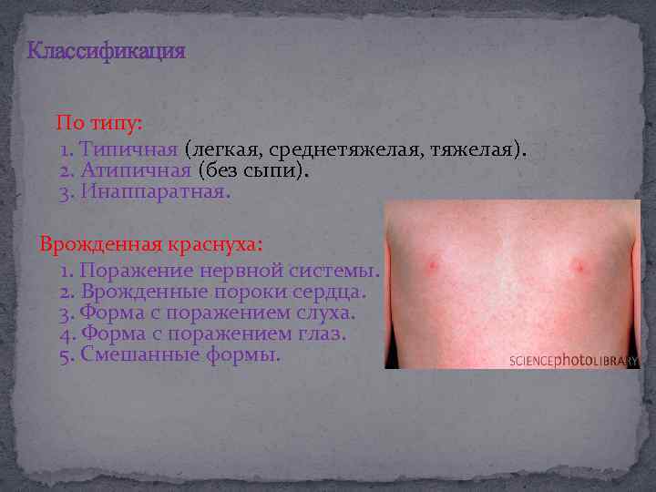 Классификация По типу: 1. Типичная (легкая, среднетяжелая, тяжелая). 2. Атипичная (без сыпи). 3. Инаппаратная.