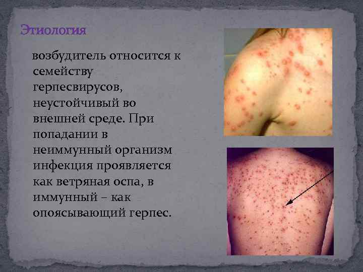 Этиология возбудитель относится к семейству герпесвирусов, неустойчивый во внешней среде. При попадании в неиммунный
