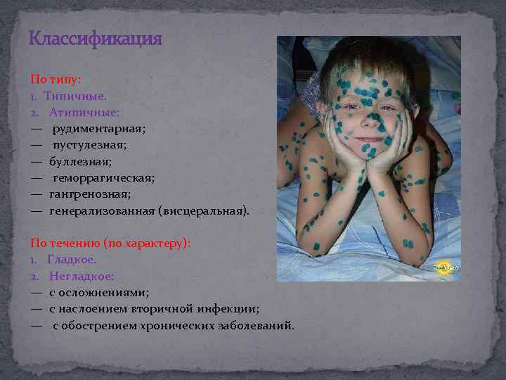Классификация По типу: 1. Типичные. 2. Атипичные: — рудиментарная; — пустулезная; — буллезная; —