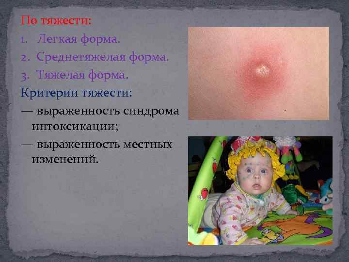 По тяжести: 1. Легкая форма. 2. Среднетяжелая форма. 3. Тяжелая форма. Критерии тяжести: —
