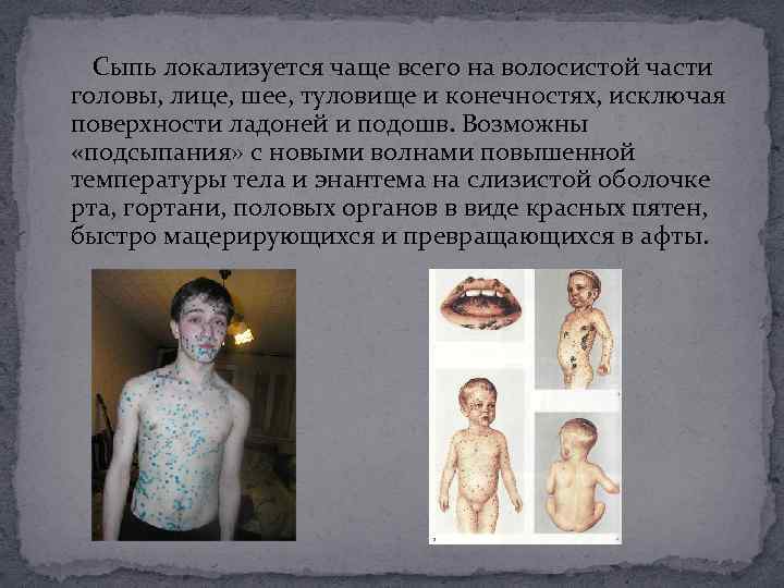  Сыпь локализуется чаще всего на волосистой части головы, лице, шее, туловище и конечностях,