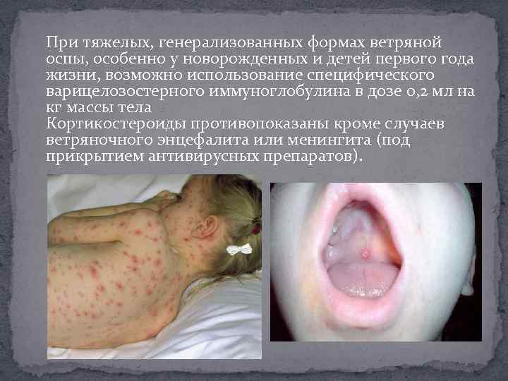 При тяжелых, генерализованных формах ветряной оспы, особенно у новорожденных и детей первого года жизни,