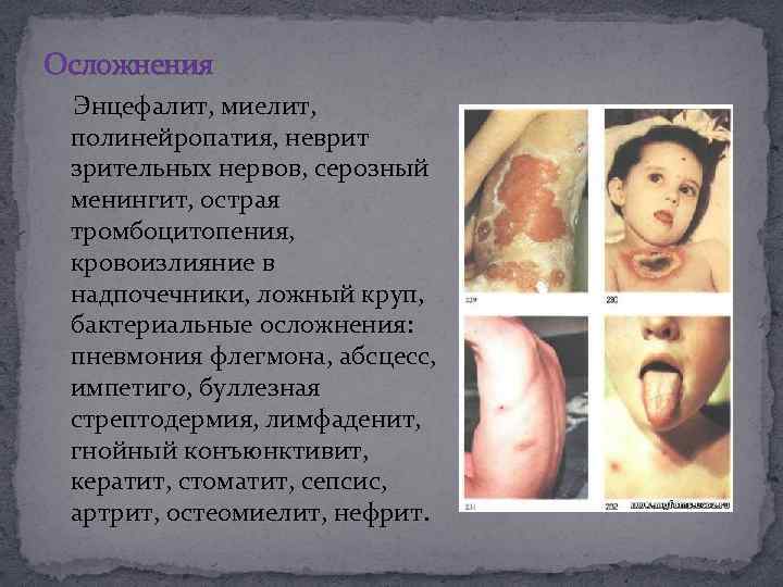 Осложнения Энцефалит, миелит, полинейропатия, неврит зрительных нервов, серозный менингит, острая тромбоцитопения, кровоизлияние в надпочечники,