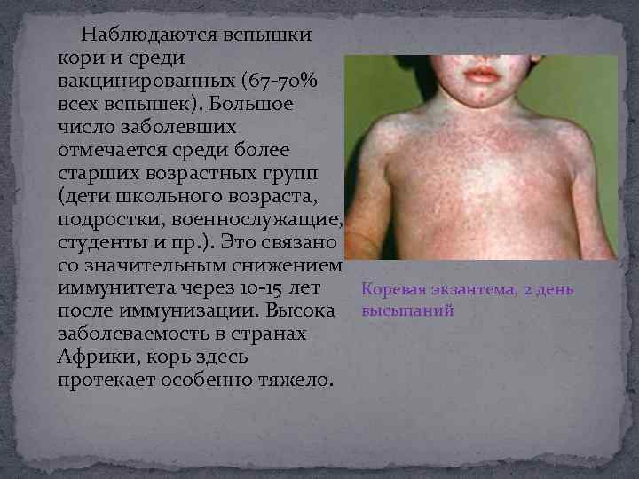 Наблюдаются вспышки кори и среди вакцинированных (67 -70% всех вспышек). Большое число заболевших
