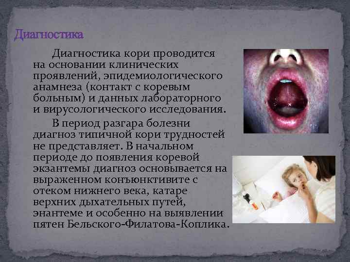 Диагностика кори проводится на основании клинических проявлений, эпидемиологического анамнеза (контакт с коревым больным) и