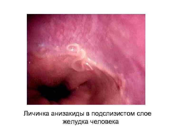 Личинка анизакиды в подслизистом слое желудка человека 
