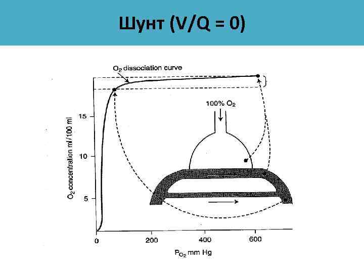 Шунт (V/Q = 0) 