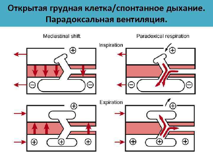 Открытая грудная клетка/спонтанное дыхание. Парадоксальная вентиляция. 