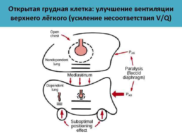 Открытая грудная клетка: улучшение вентиляции верхнего лёгкого (усиление несоответствия V/Q) 