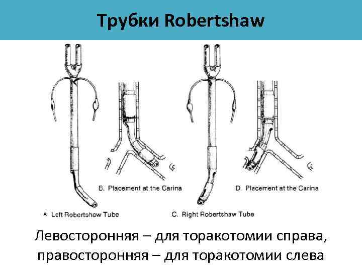 Трубки Robertshaw Левосторонняя – для торакотомии справа, правосторонняя – для торакотомии слева 