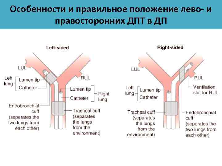 Особенности и правильное положение лево- и правосторонних ДПТ в ДП 