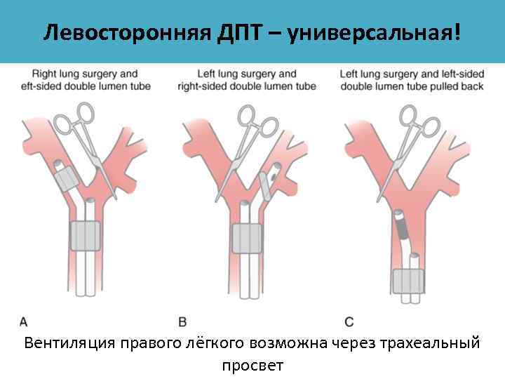 Контрапертура хирургия это