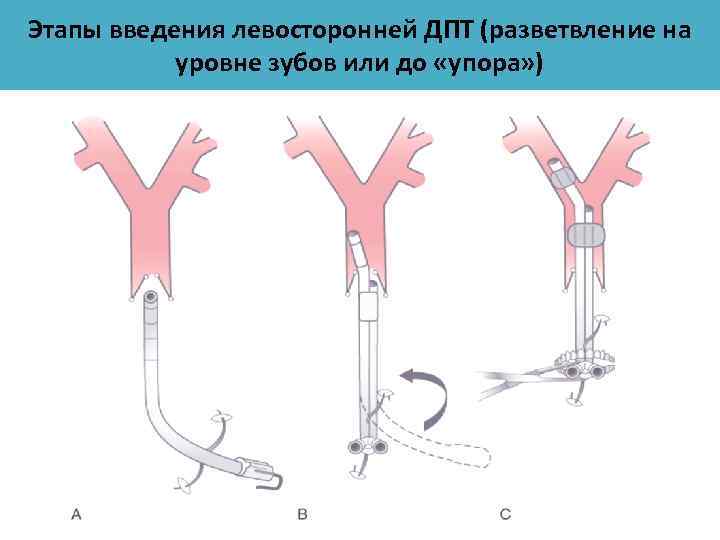 Этапы введения левосторонней ДПТ (разветвление на уровне зубов или до «упора» ) 