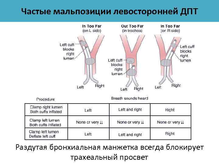 Частые мальпозиции левосторонней ДПТ Раздутая бронхиальная манжетка всегда блокирует трахеальный просвет 