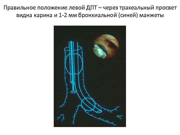 Правильное положение левой ДПТ – через трахеальный просвет видна карина и 1 -2 мм