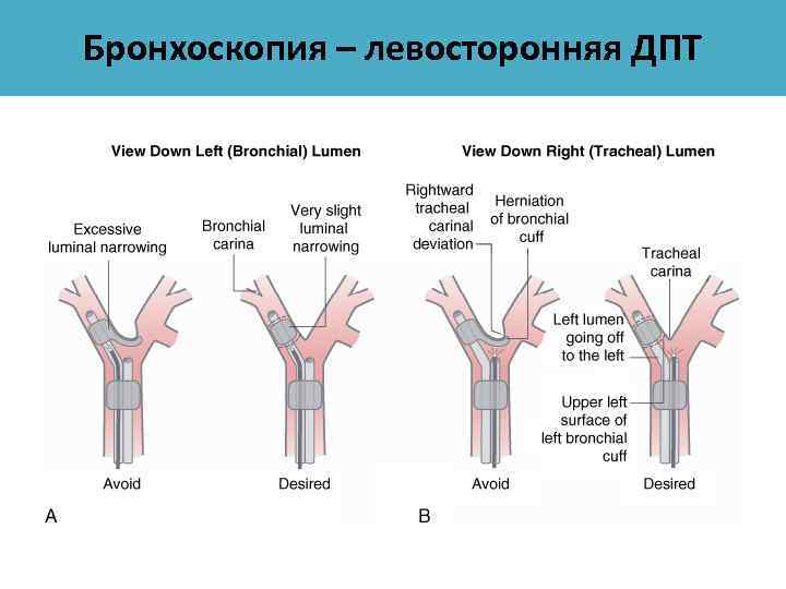 Бронхоскопия – левосторонняя ДПТ 