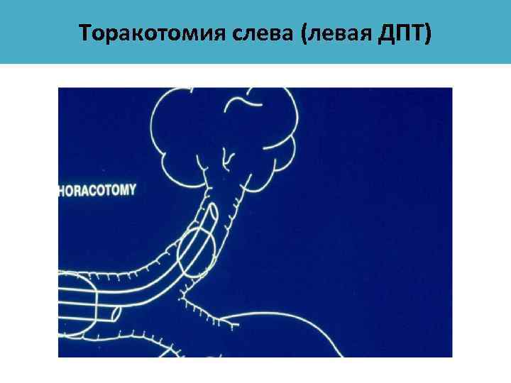 Торакотомия слева (левая ДПТ) 