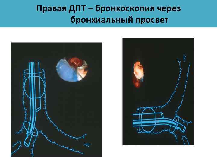 Правая ДПТ – бронхоскопия через бронхиальный просвет 