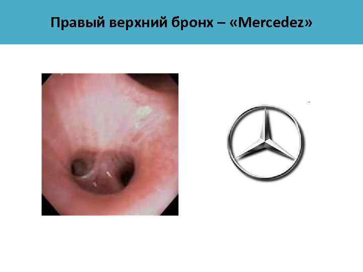 Правый верхний бронх – «Mercedez» 