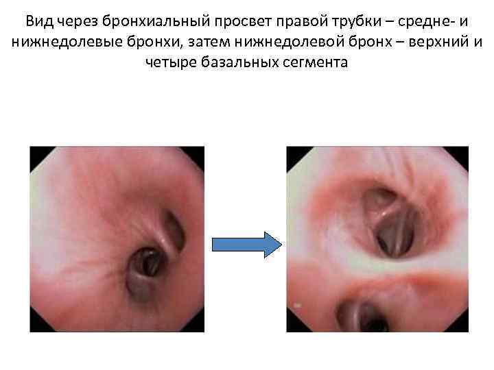 Вид через бронхиальный просвет правой трубки – средне- и нижнедолевые бронхи, затем нижнедолевой бронх