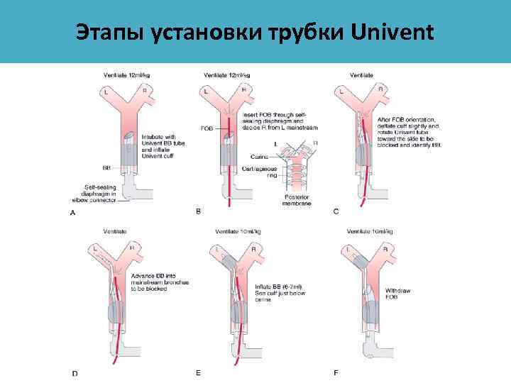 Этапы установки трубки Univent 