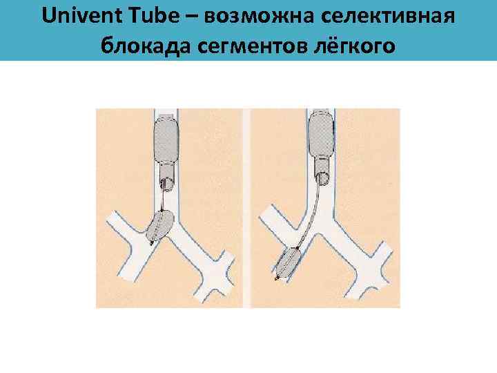 Univent Tube – возможна селективная блокада сегментов лёгкого 