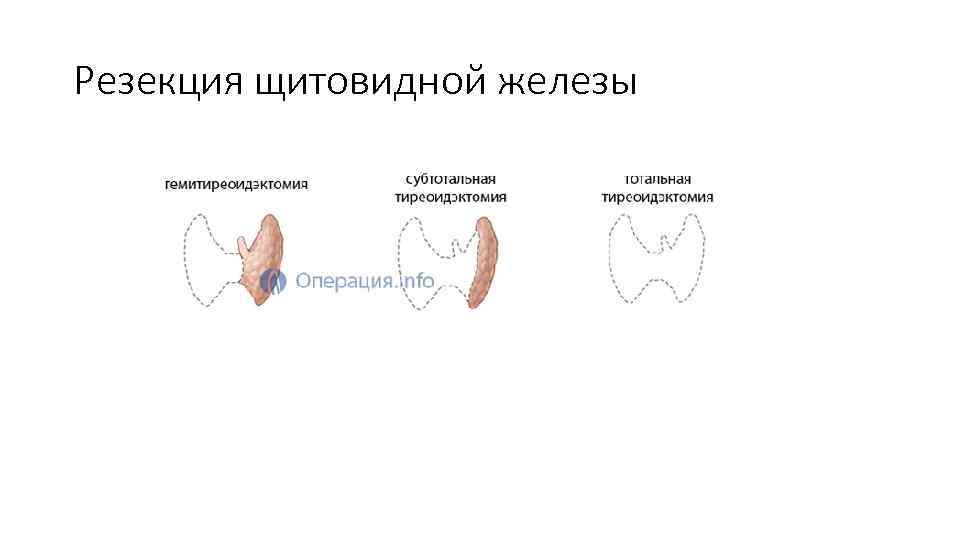 Резекция щитовидной железы 