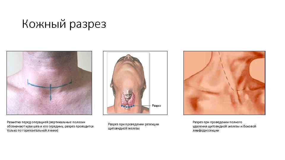 Кожный разрез Разметка перед операцией (вертикальные полоски обозначают края шва и его середину, разрез