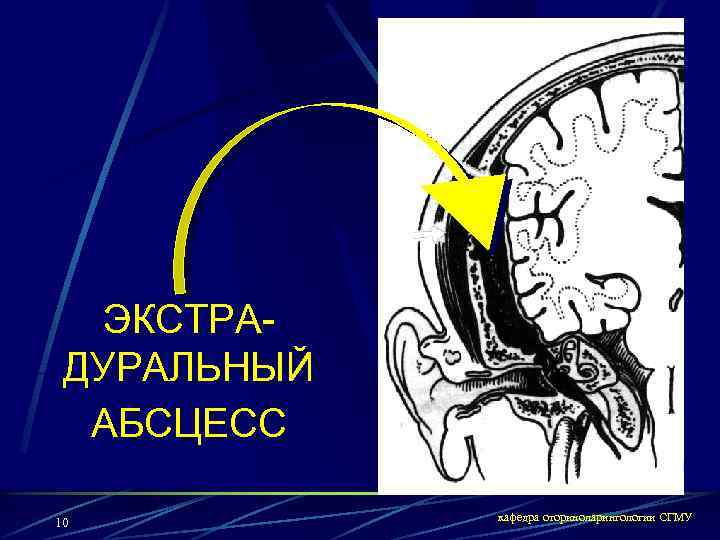 ЭКСТРАДУРАЛЬНЫЙ АБСЦЕСС 10 кафедра оториноларингологии СГМУ 